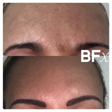 bfx before after 3